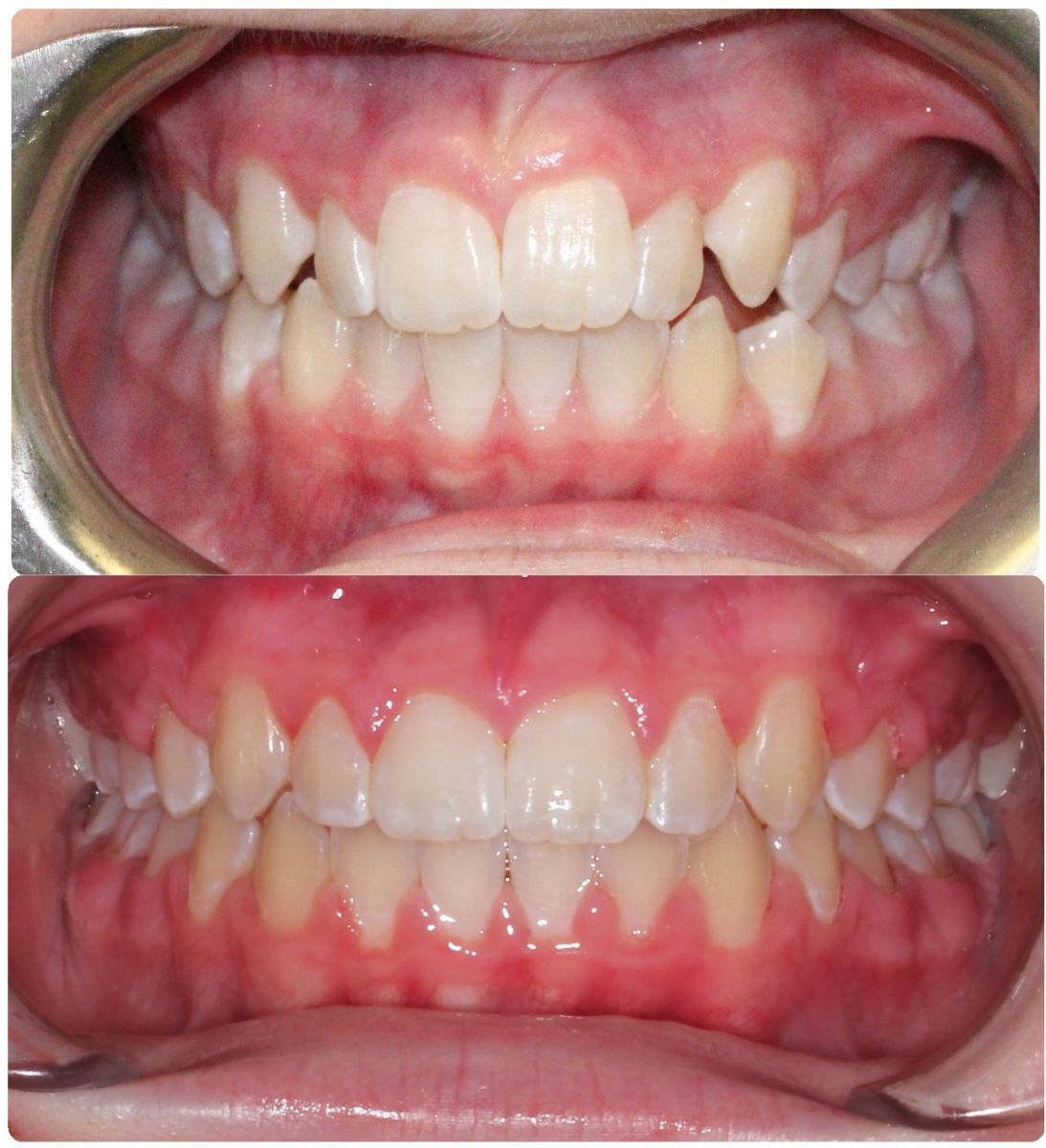 Before and After Douglas Dental Roseville CA